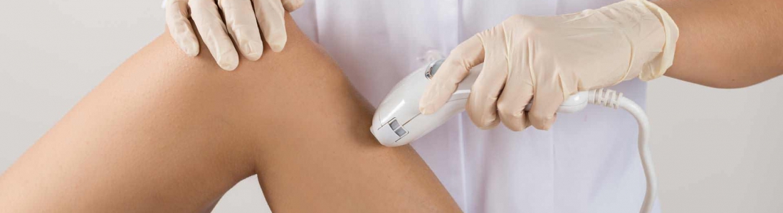 L’épilation laser est-elle vraiment définitive ?
